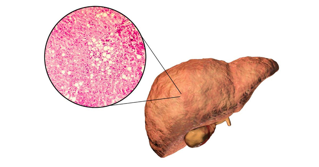 Illustration of a liver with a close-up microscopic view showing liver cells, highlighting the effects of fatty liver disease at the cellular level